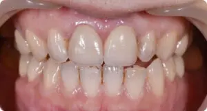 全瓷冠 蔡忠澍4 small