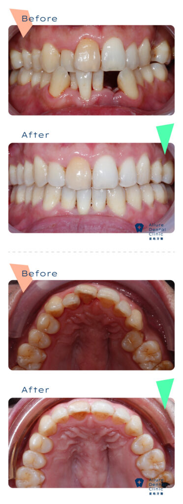 牙齒矯正案例 周霖晉醫師2 1