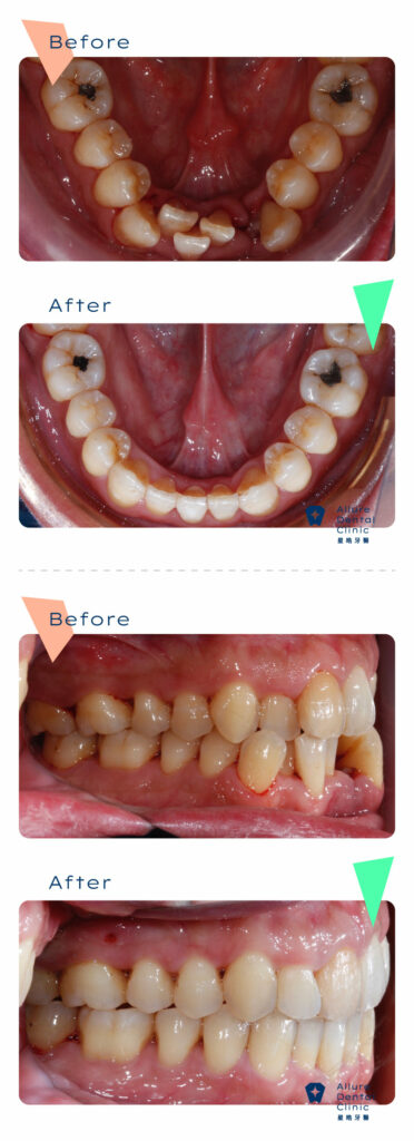 牙齒矯正案例 周霖晉醫師2 2