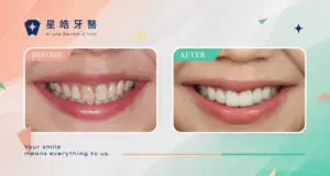 案例分享 33 貼片案例 比熊