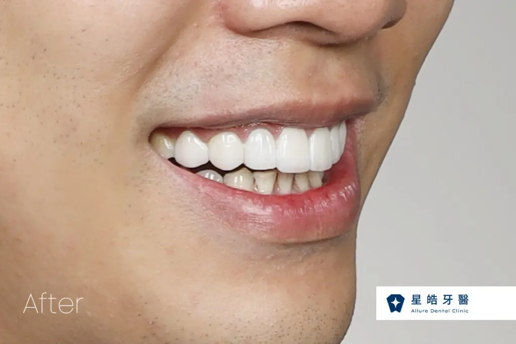 veneercase geitwei after3