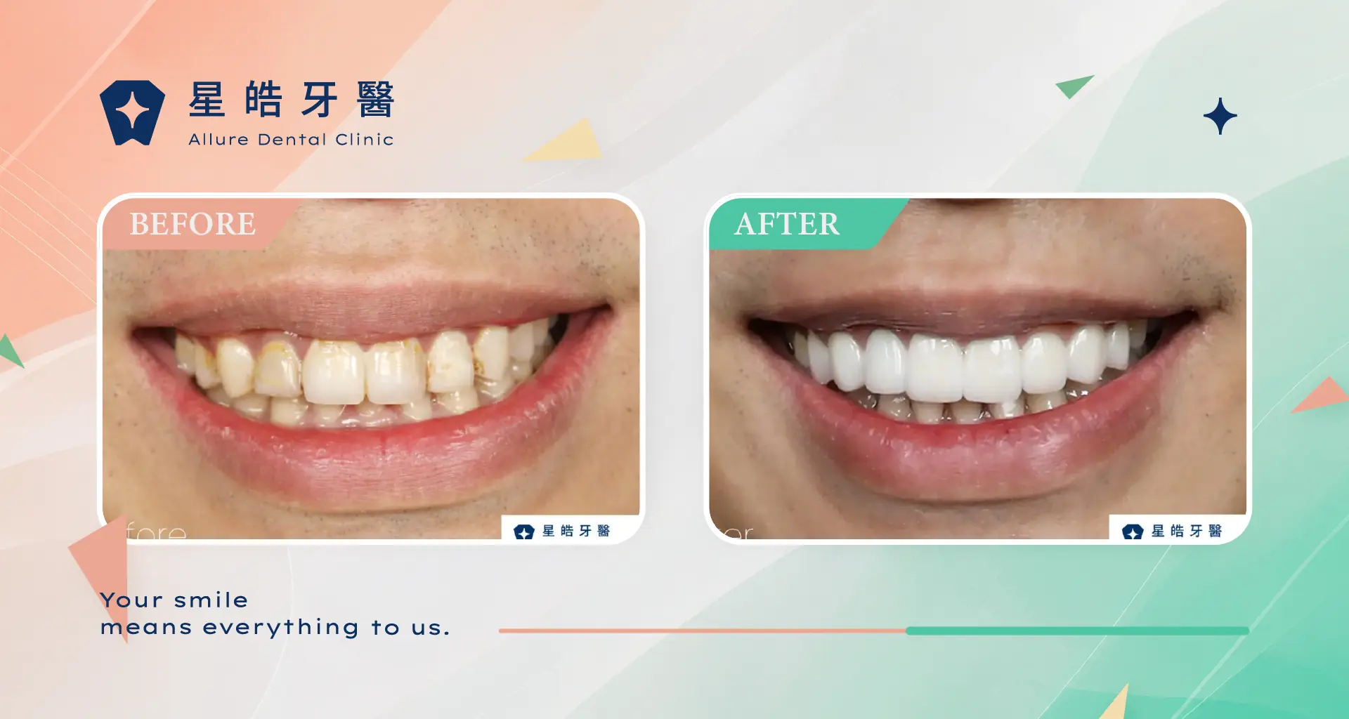 Read more about the article 貼片案例-希露弟弟啃雞腿