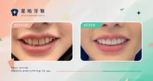 陶瓷貼片可以改善什麼？牙縫、缺角、齒色不均案例分享