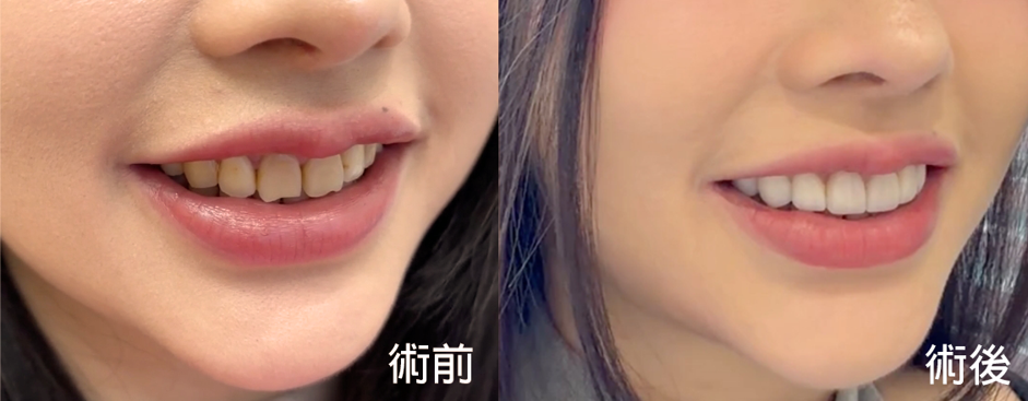 陶瓷貼片術前術後側面比較，自然調整牙齒比例與微笑曲線