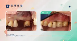 植牙流程
