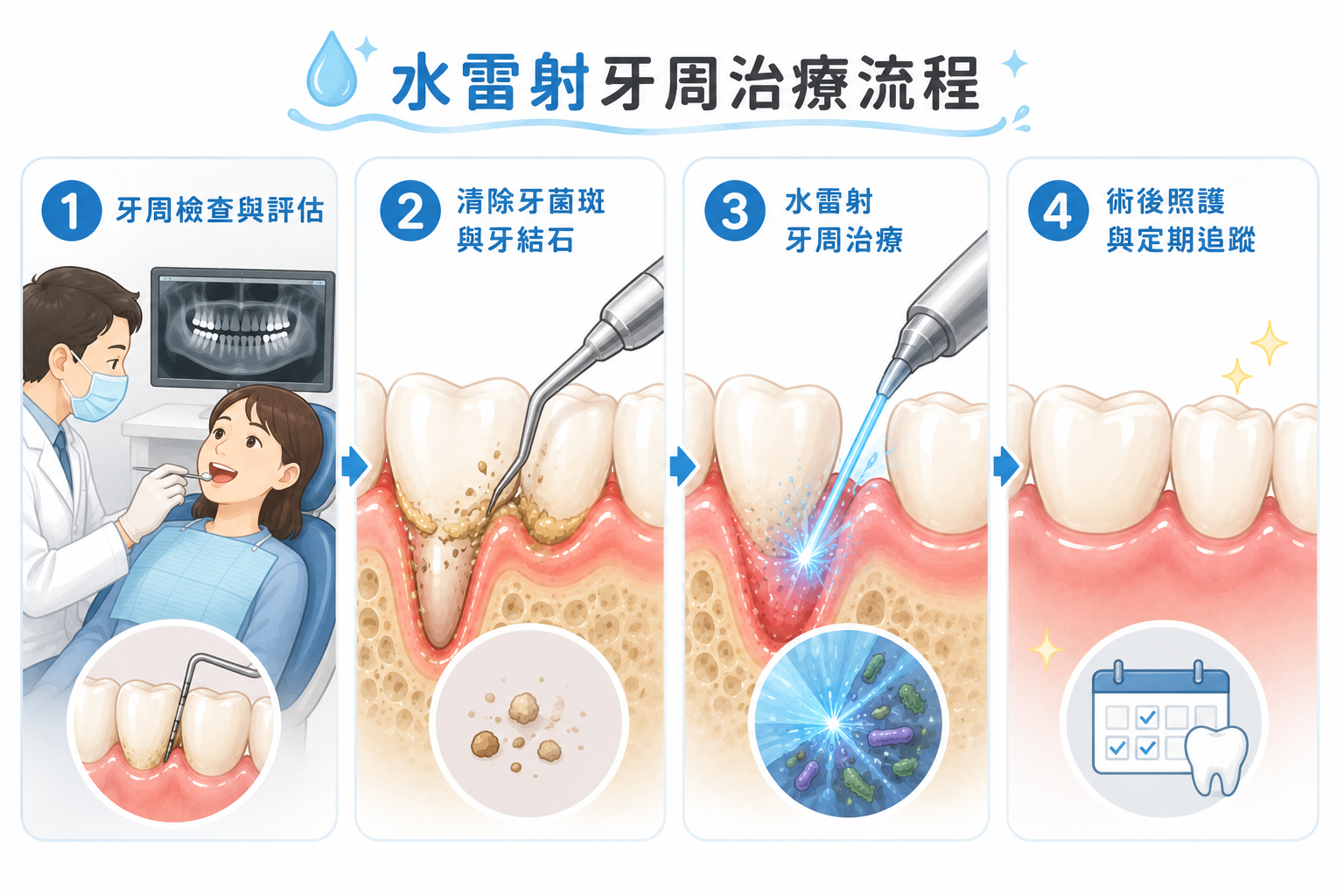水雷射牙周治療流程4步驟示意圖